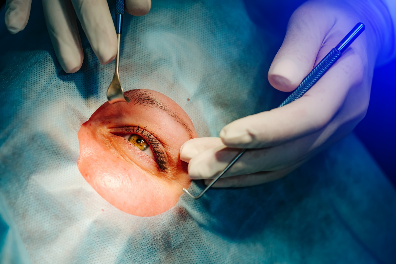 Retinal Detachment Surgery